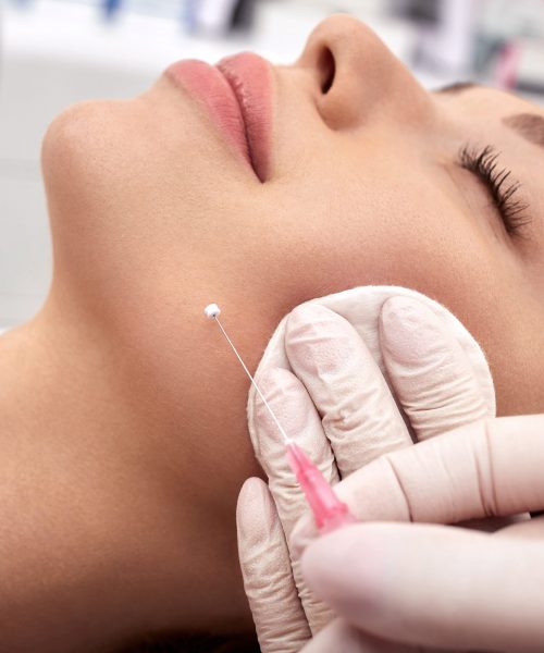 Woman,Receives,A,Facelift,,Procedure,Mesothreads,Lifting,Skin.,Cosmetic,Surgery,
